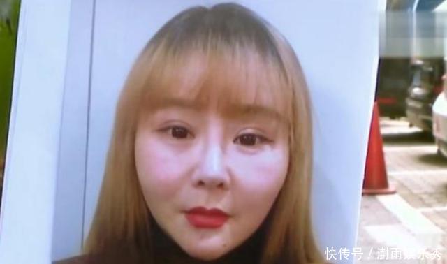 花了13000元做脸部埋线，术后美颜相机都救不了？姑娘：脸更胖了