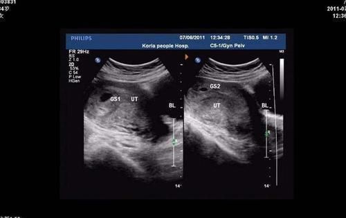 用时|同样是顺产,一个用时30分钟,一个却用时5小时,只因胎位不同