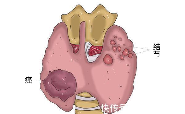 恶性|甲状腺结节分等级，发展到几级会成为癌症？甲状腺可以自愈吗？