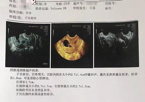 孕酮|确定怀孕后，第一次产检是在什么时候？超过这个时间，就晚了