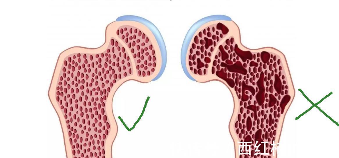 油条|3种食物少吃,或会“加速”骨质疏松!医生:想养好骨,要管住嘴