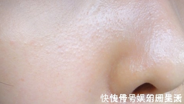 老年斑|肝脏也要“洗洗澡”,别让肝毒招来肝硬化,威胁我们身体