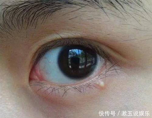 丘疹|长了脂肪粒怎么办不能用手抠也不能抓挠,教你真正的去除办法