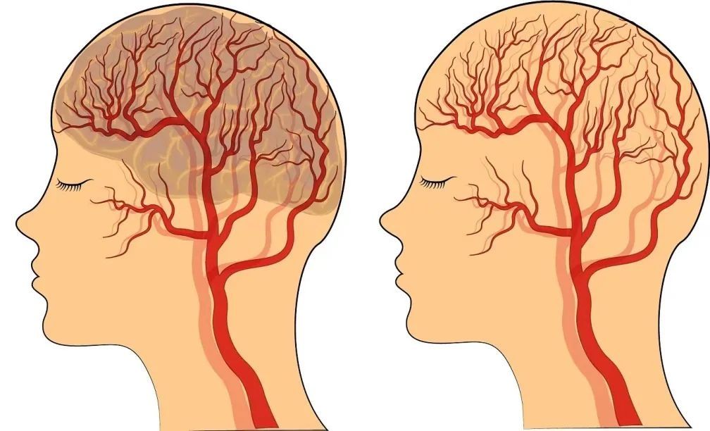 脑血管病|这种病，被称作“人类健康的头号杀手”！每21秒就有1人因它死亡→