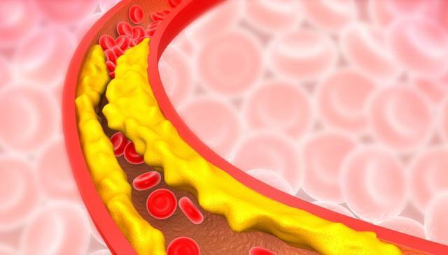 动脉粥样硬化斑块|终于找到高血脂的真凶了!医生四大错误观念,早改早安全