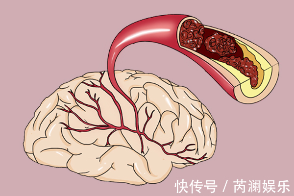 高血脂患者|明明身材不胖，为什么查出来高血脂3类人要引起重视