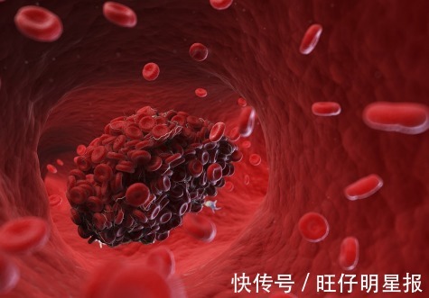 血脂|高血脂的“祸根”不止是油,经常吃这3物,血脂会黏如“粥”