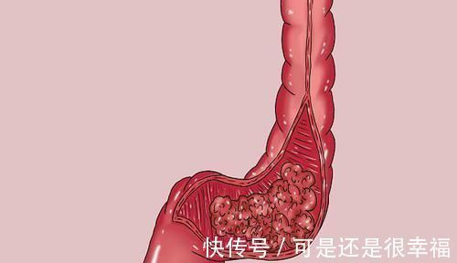 高蛋白食物|癌症患者,到底是吃肉好还是吃素好?肿瘤医生:需谨记4个字