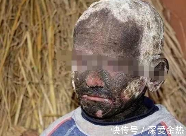 绝症|男孩得奇怪绝症,8岁时变成一尊石像,医院检查后大骂父母无知