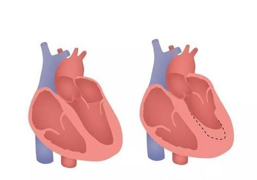 高血压|最适合老年人服用的降压药是坎地沙坦，医生告诉你为什么