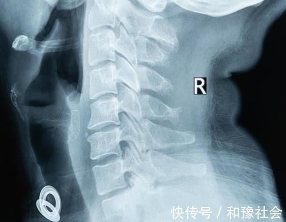 腕管综合征|平时手麻不当回事,暗藏5大病根,极有可能是中风前的征兆!