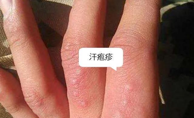 汗疱疹|夏天宝宝手上长的小水泡是什么?这还是宝宝的手吗?要紧不?