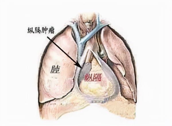 纵隔肿瘤|江西大叔胸部长出巨大肿瘤，气管被压迫得只剩一线天，为了救命，医生也是拼了