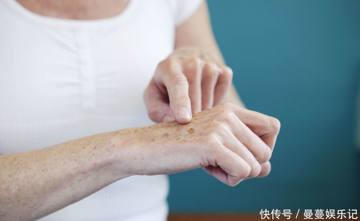 为何有些人没到60岁,身上就长老人斑,而有些人却干干净净?