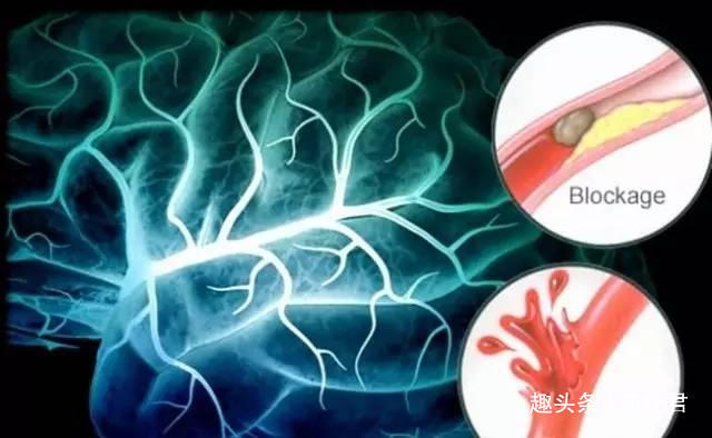 发作|医生脑供血不足,就是一次“小中风”!做好5件事,保血管安全
