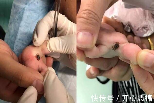 床上用品|5岁孩子被“怪虫”咬,奶奶临危不乱救了孙女,医生都佩服