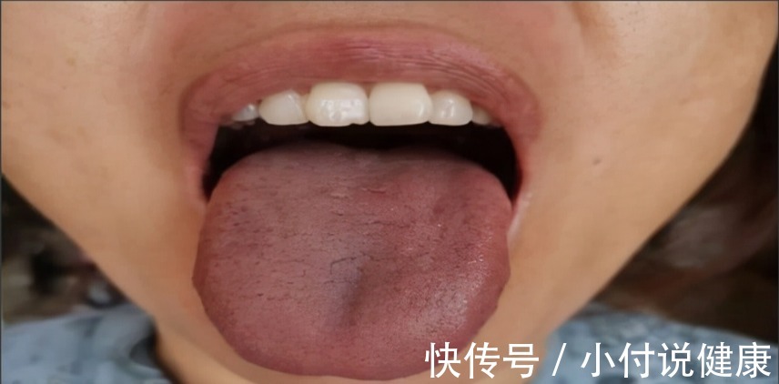 体质|两个位置测血瘀，一个中成药化淤血，4种血瘀体质了解一下