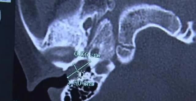 耵聍|五岁男孩出生起就没有掏过耳垢结果他第一次掏,花了5000元
