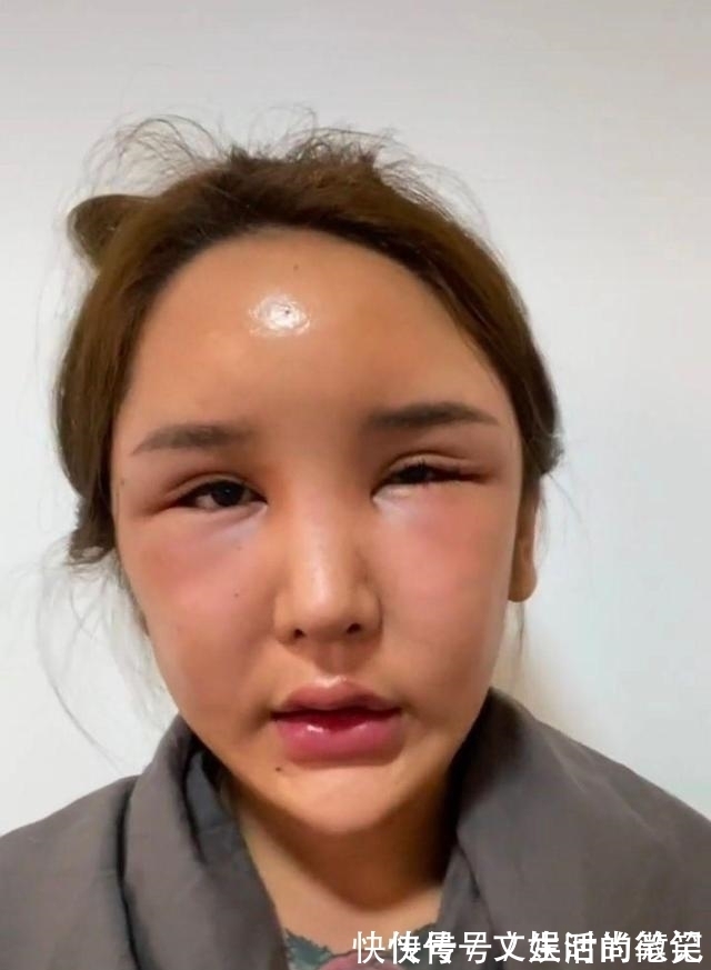 巅峰照 8年的整形手术花费了100多万,光额头就打了200多支玻尿酸