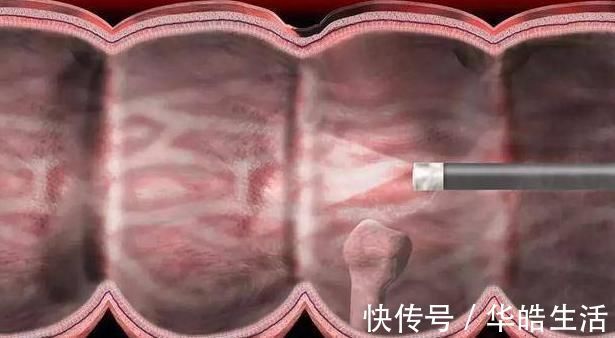 肠镜检查|有三种息肉最好及时切除,拖延太久就会变成恶性肿瘤!你清楚吗?