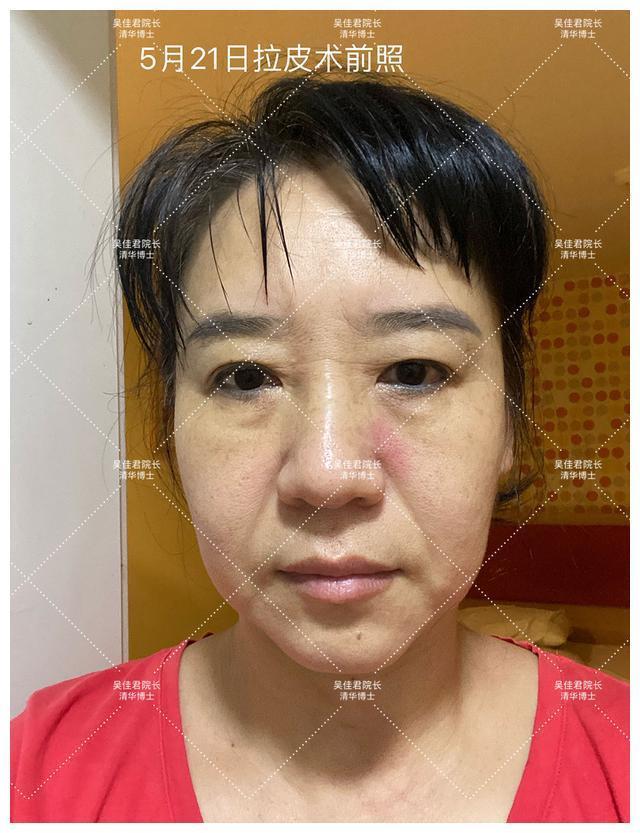 面部 51岁小拉皮术后1个月,我想跟大家说点真心话