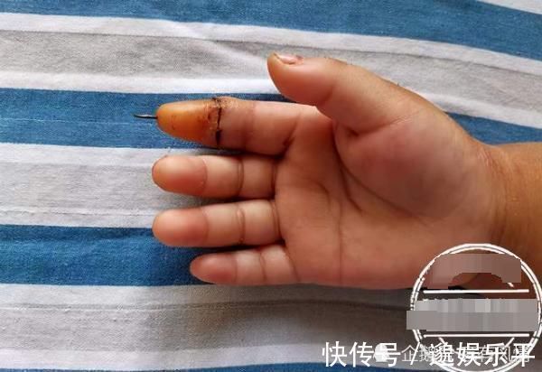女童|2岁女童活泼好动,手指当场被切断! 父母就在一旁