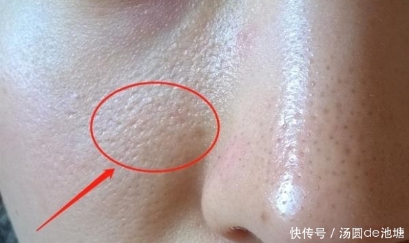 肝解毒能力下降,脸上有“呼救”,若出现,提