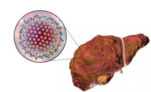 肝脏|医生提示：身体出现6个症状，十有八九是肝硬化，占一个也要CT