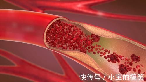 疾病|肺癌最可怕的不是疾病本身，而是伴随的并发症