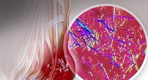 尿酸|它是痛风的“超强天敌”,长期吃下去,尿酸就会下降