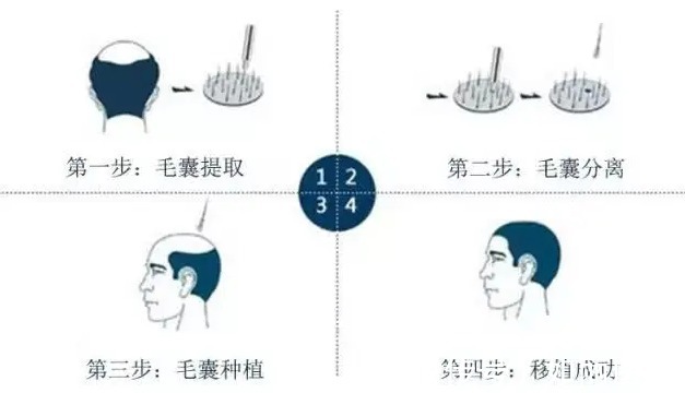 多方面 头顶植发大概需要多少个单位，多少钱？2022美发攻略教你！