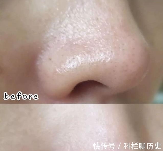草莓鼻|女生“鼻子黑头”泛滥消不掉?教你3招,助你轻松摆脱“草莓鼻”