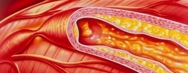 洋葱|每天吃洋葱可以降血脂北大教授大错特错,降血脂的是这件事