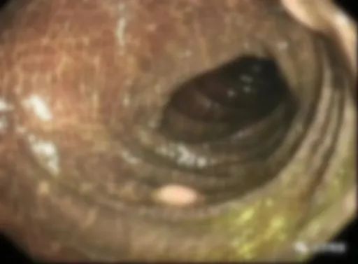 便秘|热搜第一！一女子的检查报告吓坏网友