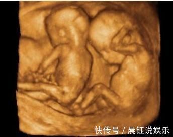 全家|孕妈怀上三胞胎全家开心,医生抱出第三个孩子后,又有意外发现!