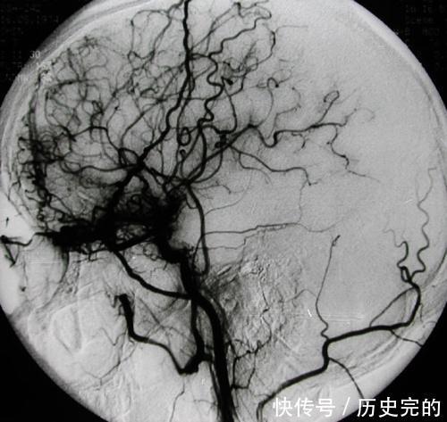 研究生突发头晕呕吐,一查竟是脑出血,患者没到竟离死亡这么近