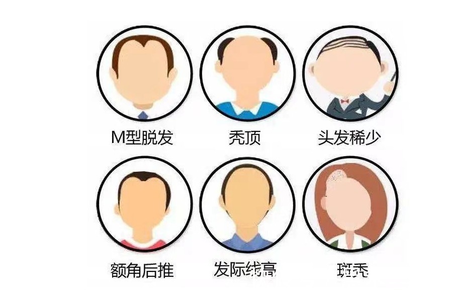 脱发者 黑米3D纹发:关于植发的一些事实《5-8》