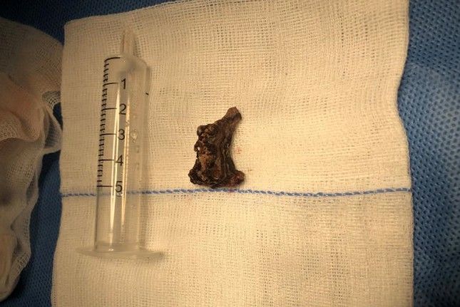 流涕|老人常年鼻塞流涕，近期突然流“血涕”，元凶竟是一块“石头”