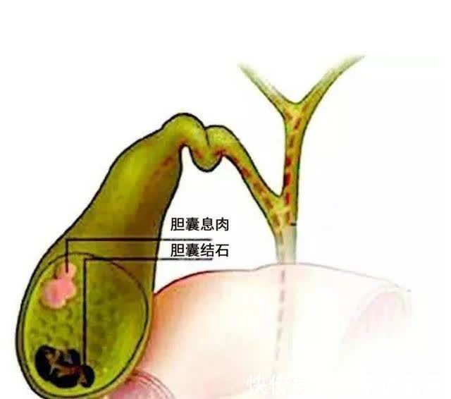 胆囊息肉|胆囊息肉你知多少?这时候了解,还不算晚