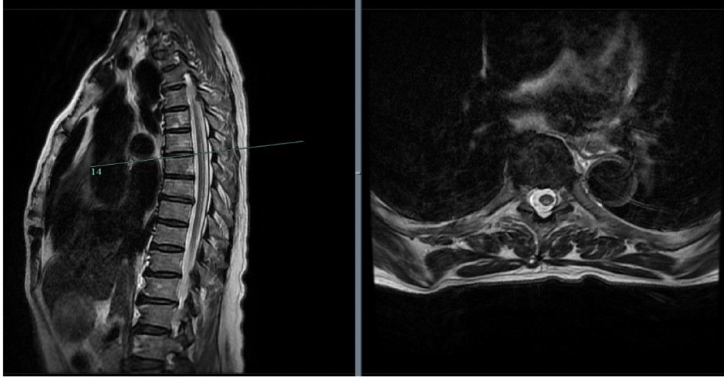 素食|65歲阿姨被施“定身咒”？全身僵硬動不了！出毛病的竟是胃……