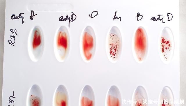 母儿|母儿血型不合的内容,你到底了解多少希望你不要错过这篇文章