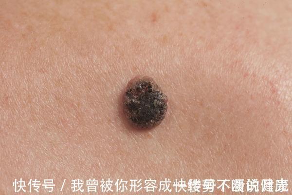 部位|哪种“痣”是危险分子?医生提醒:长在这3处的痣,要格外当心
