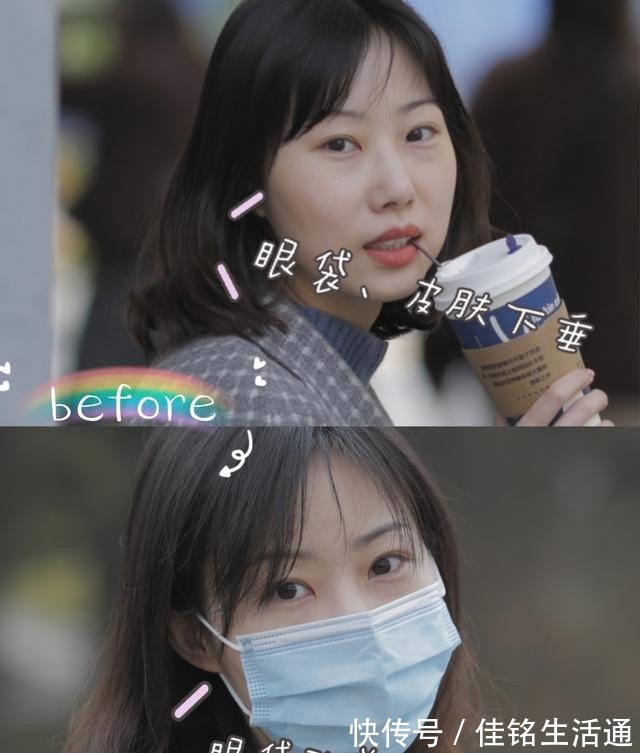 周大 花同样的钱做眼部热玛吉值得吗丨眼部热玛吉初体验!