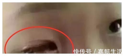 男孩|仅20分钟，男孩眼睛被“熔化”，这东西家家都有，父母们别大意