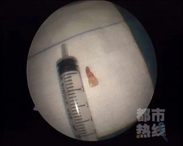 牙齿|一6岁女童鼻子里“长牙”,取出后发现竟是三年前失踪的门牙