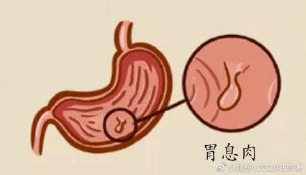 胃窦部|胃息肉——直径大于2厘米要切除