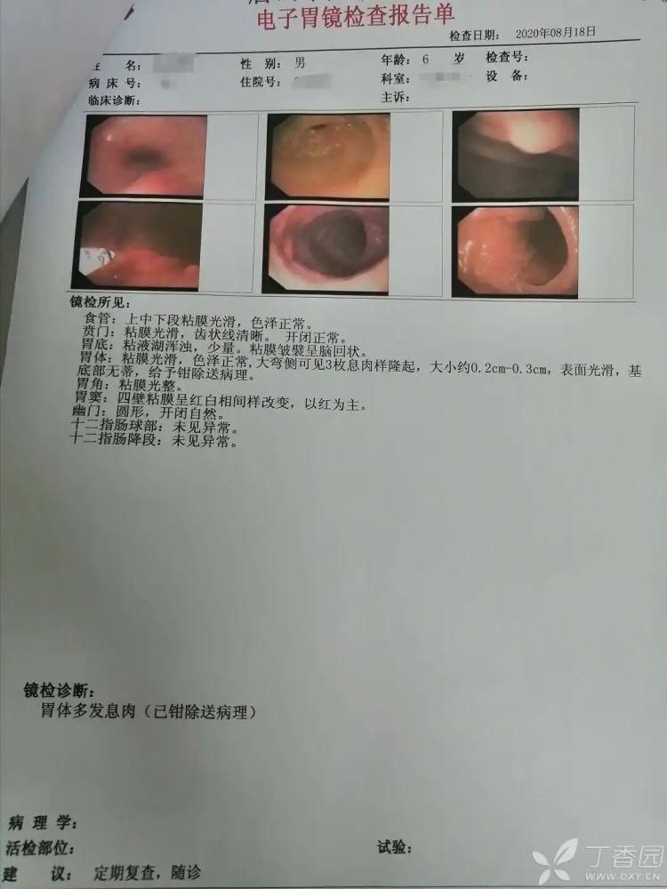 结肠|6岁孩童口唇满布黑斑,竟诊断为结肠多发息肉,你怎么看?