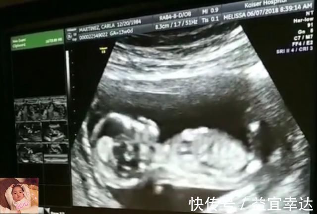 胎儿|除了睡觉,胎儿如何每天在肚子里都干啥宝宝小日子开心到飞起