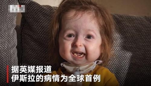 本杰明巴顿|全球首例!2岁女童却有80岁的脸,网友:希望能像本杰明巴顿一样