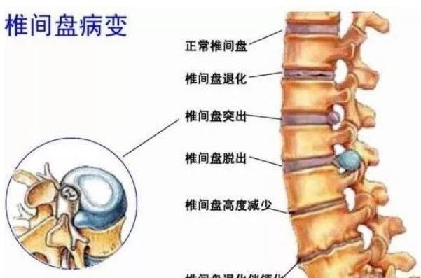 腰椎疾病|腰部疼痛的5大原因+4大护理方法，帮你轻松赶走腰椎疾病